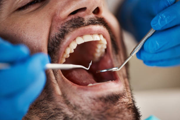 Best Emergency Tooth Extraction in Robins Af, GA